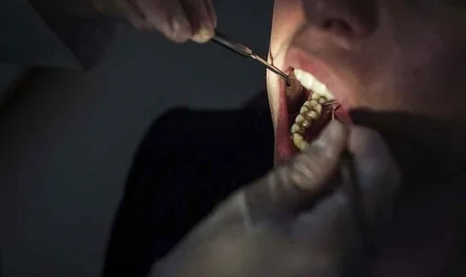 "Yirmi Yaş Dişleri Değerleniyor: Özel Saklama Trendi Başladı"